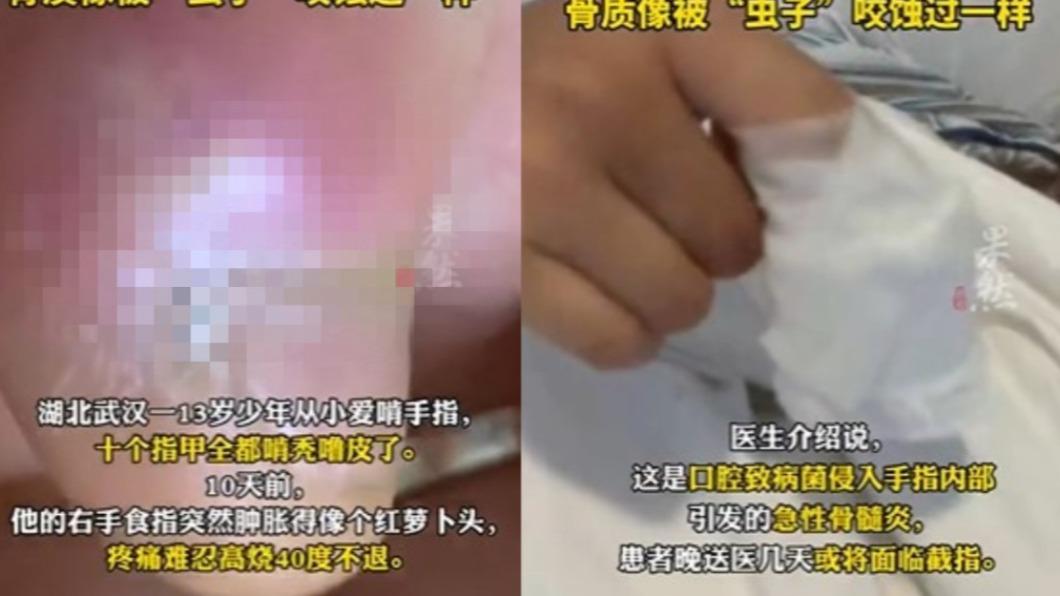 少年因細菌感染導致手部腫脹。(圖/翻攝自微博)