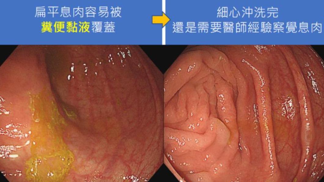 健檢正常3年後罹大腸癌！醫曝「扁皮息肉」元兇　揭4特性