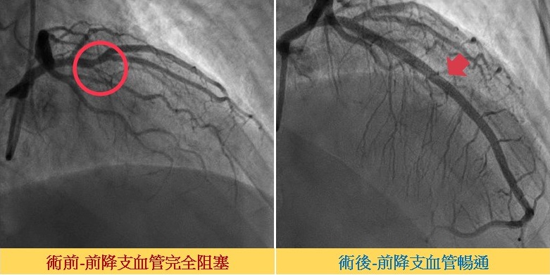左:手術前患者的前降支血管完全阻塞。右:手術後前降支血管暢通。(圖片提供/新竹中醫大)