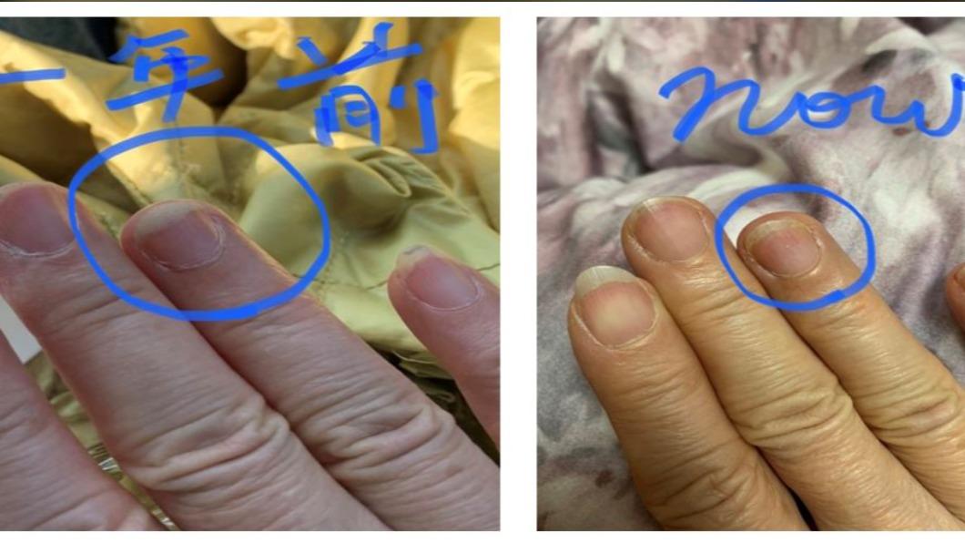 患者維生素D不足,導致指甲脆弱。(圖/診所提供)