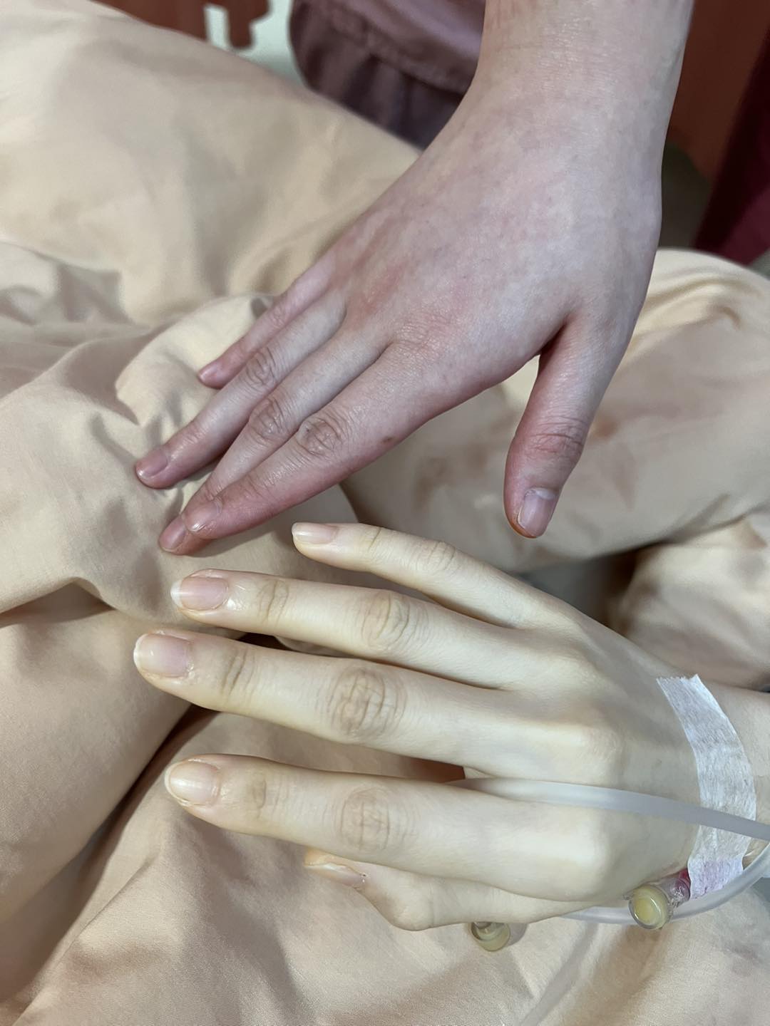 女性手掌明顯蒼白是貧血警訊。(圖/翻攝自婦產科全方位專家 尹長生 醫師臉書)