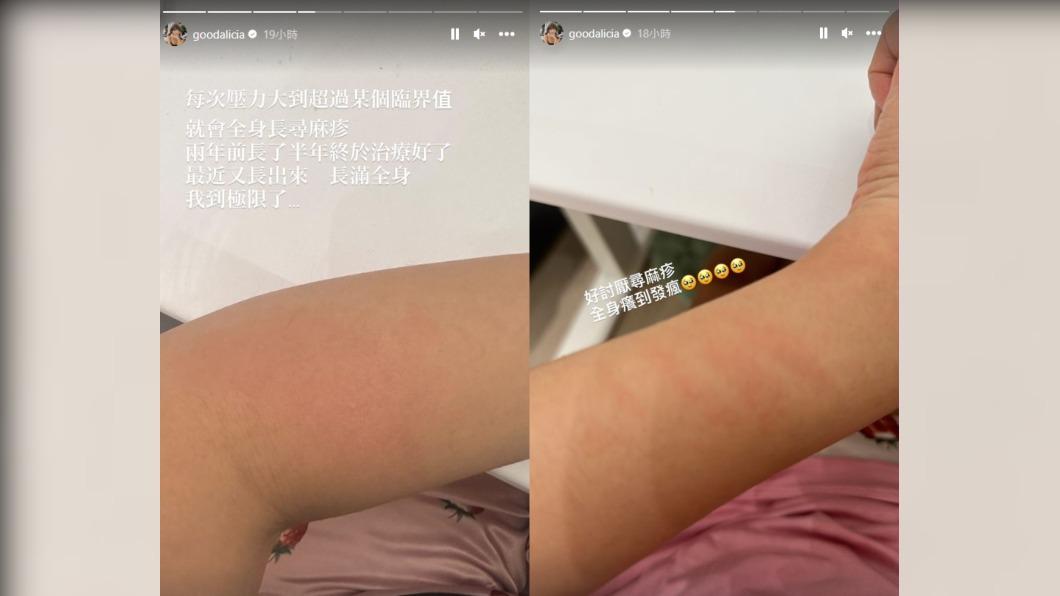 愛莉莎莎因壓力太大長滿蕁麻疹。（圖／翻攝自goodalicia IG）