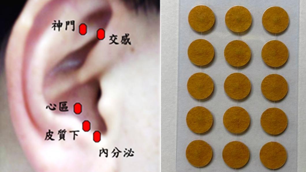 中醫「耳穴貼壓」治療。（圖／院方提供）