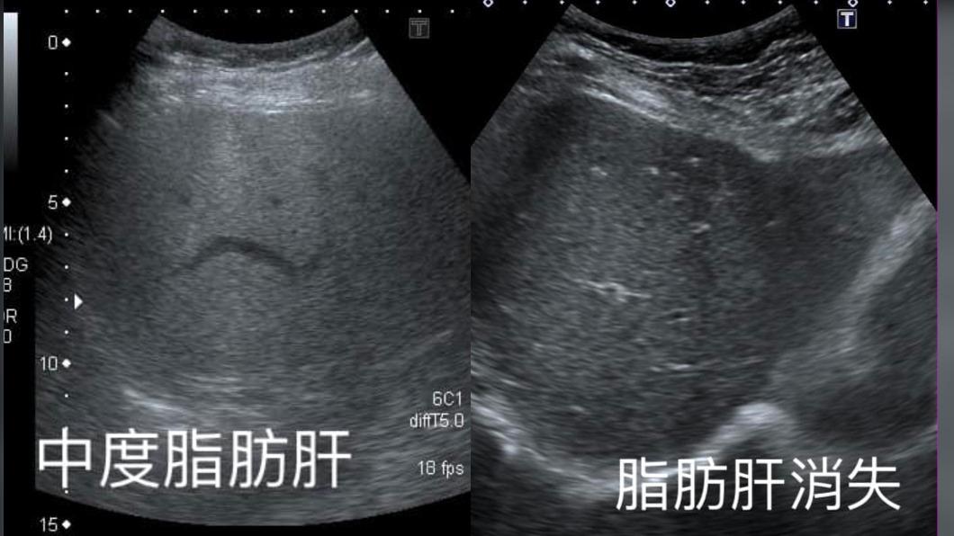 阿姨罹患中度脂肪肝,少吃水果後竟全消失。(圖/翻攝自錢政弘胃腸肝膽科醫師臉書)