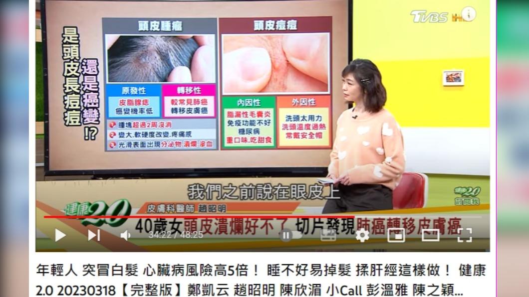 頭頂長痘要小心恐是癌細胞。(圖/翻攝自健康2.0 YouTube)