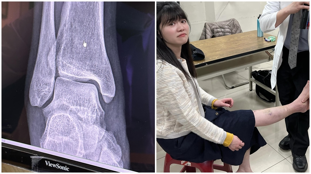 高嘉瑜美機場出意外!照X光醫吐「最壞結果」 恐開刀嚇哭了