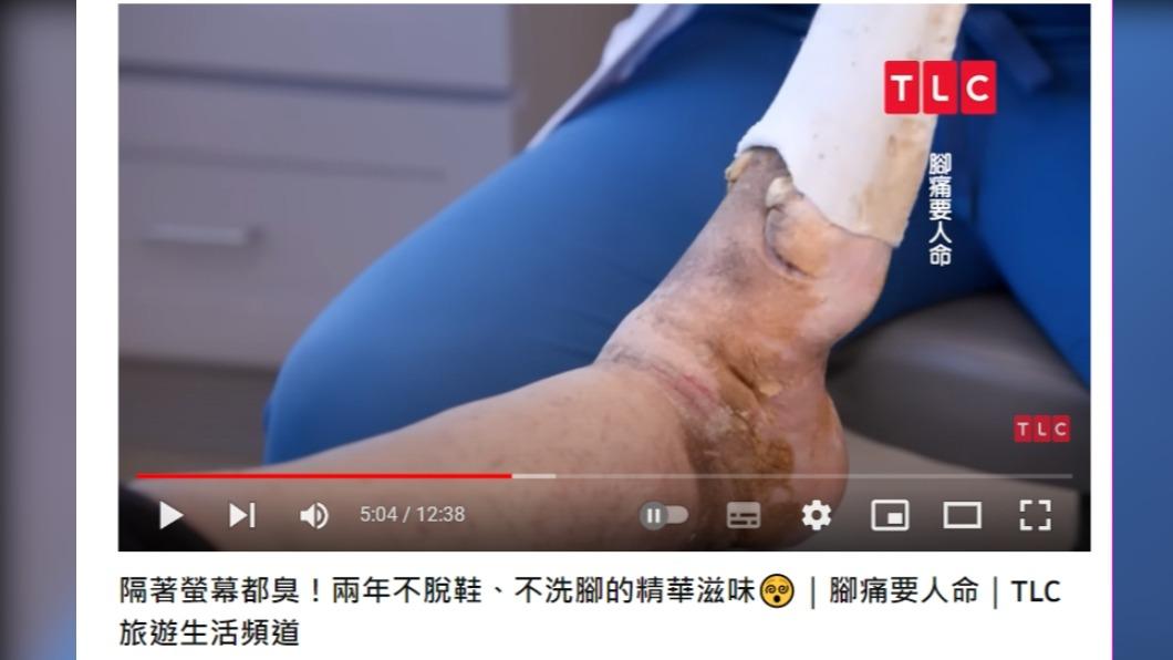當懷諾娜的左腳重見光明時,診間開始瀰漫惡臭。(圖/翻攝自TLC 旅遊生活頻道YouTube)