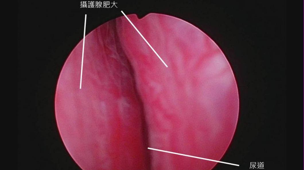 患者的攝護腺肥大導致排尿困難。(圖/診所提供)