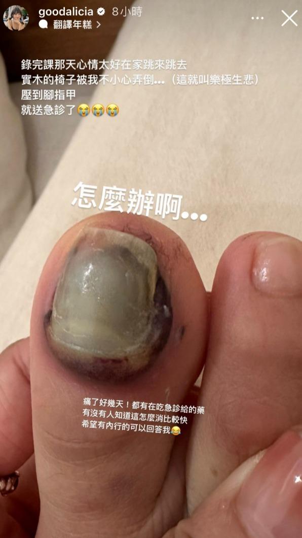 愛莉莎莎的腳指甲嚴重移位。(圖/翻攝自愛莉莎莎臉書)