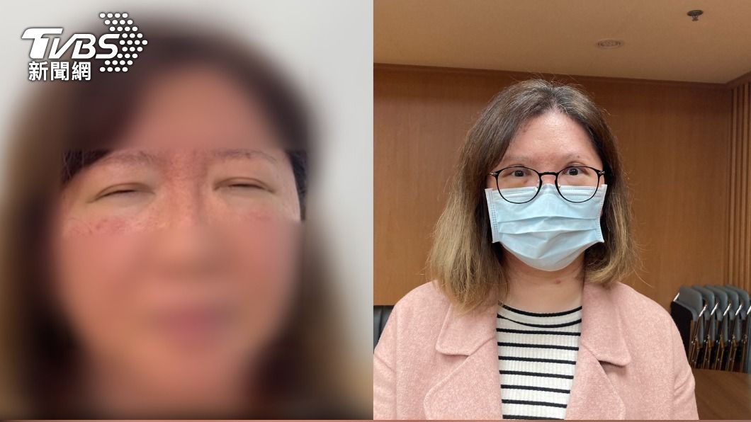 像「鬼壓眼」!港女眼睛睜不開三年 找嘸病因來台求解