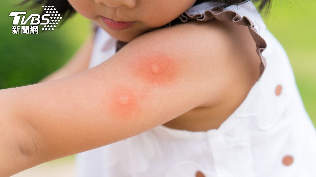 遭蚊蟲叮咬!嬰幼兒避開薄荷、樟腦藥膏 「這成分」效果最好