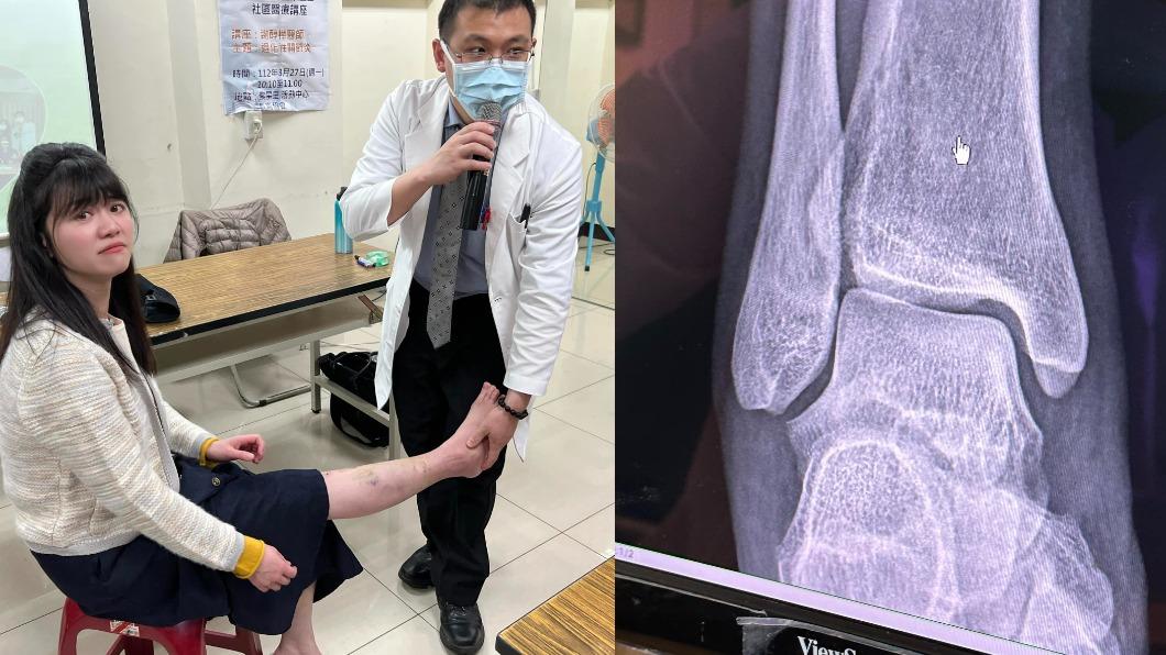 高嘉瑜腳踝不慎遭行李箱壓傷,醫師診斷告知恐開刀。(圖/高嘉瑜臉書)