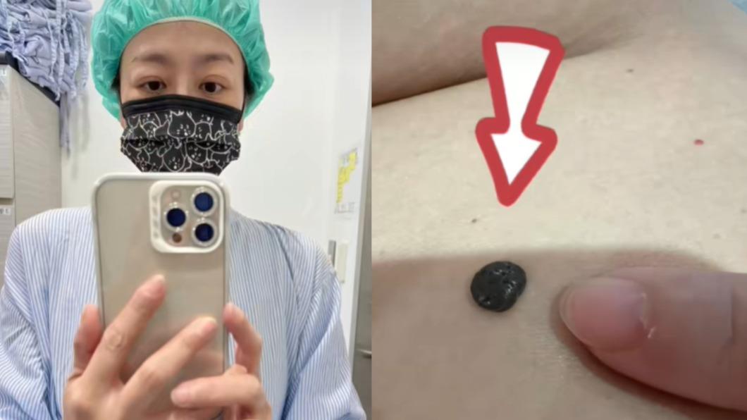 唐玲肚子上的黑痣變得腫大,緊急安排手術切除。(圖/翻攝自唐玲臉書)