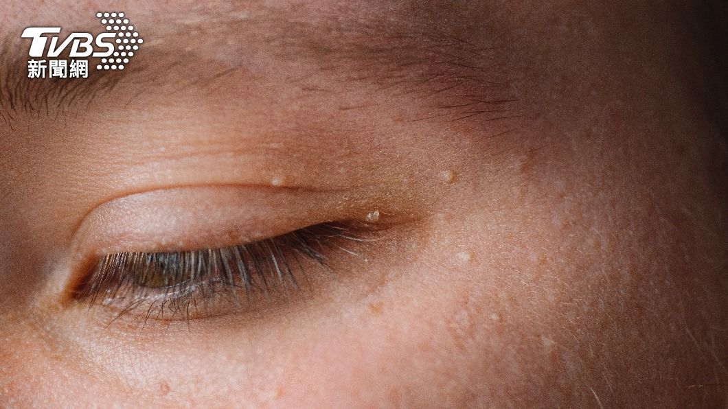眼周出現小顆粒!快用顏色分辨 「黃色斑塊」恐血脂異常