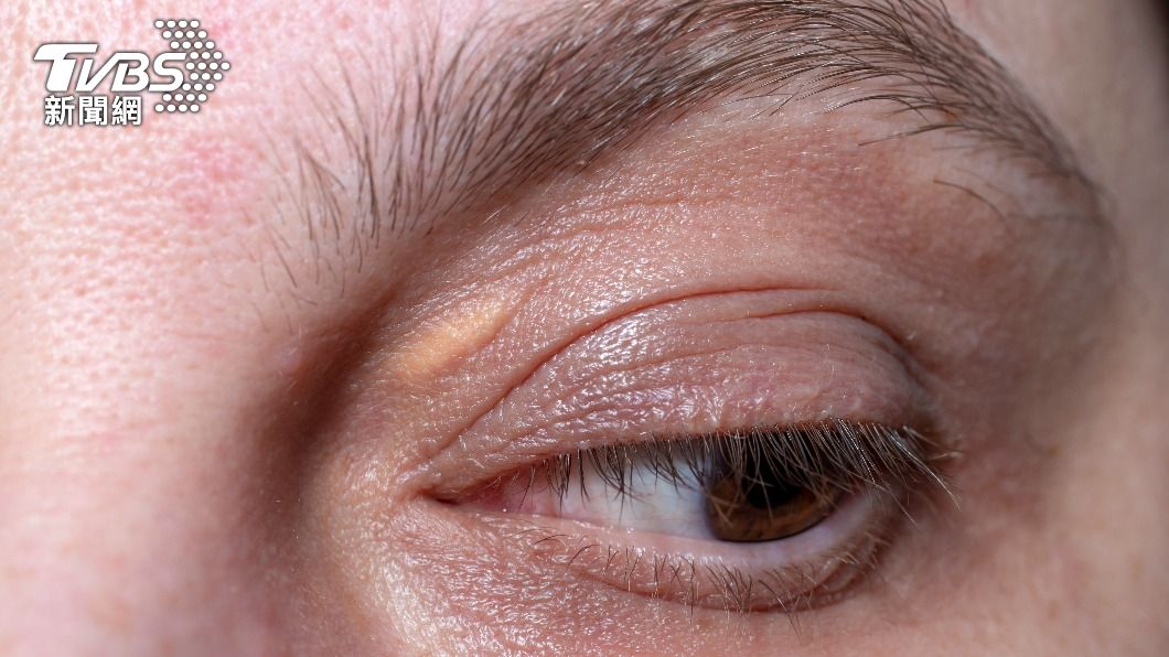 如果在眼瞼部分出現黃色柔軟斑塊，可能是眼瞼黃斑瘤。（示意圖／shutterstock達志影像）