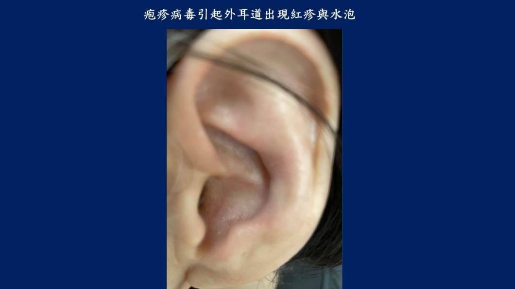 帶狀疱疹病毒常引起外耳道與耳後紅疹與水泡。(圖/診所提供)