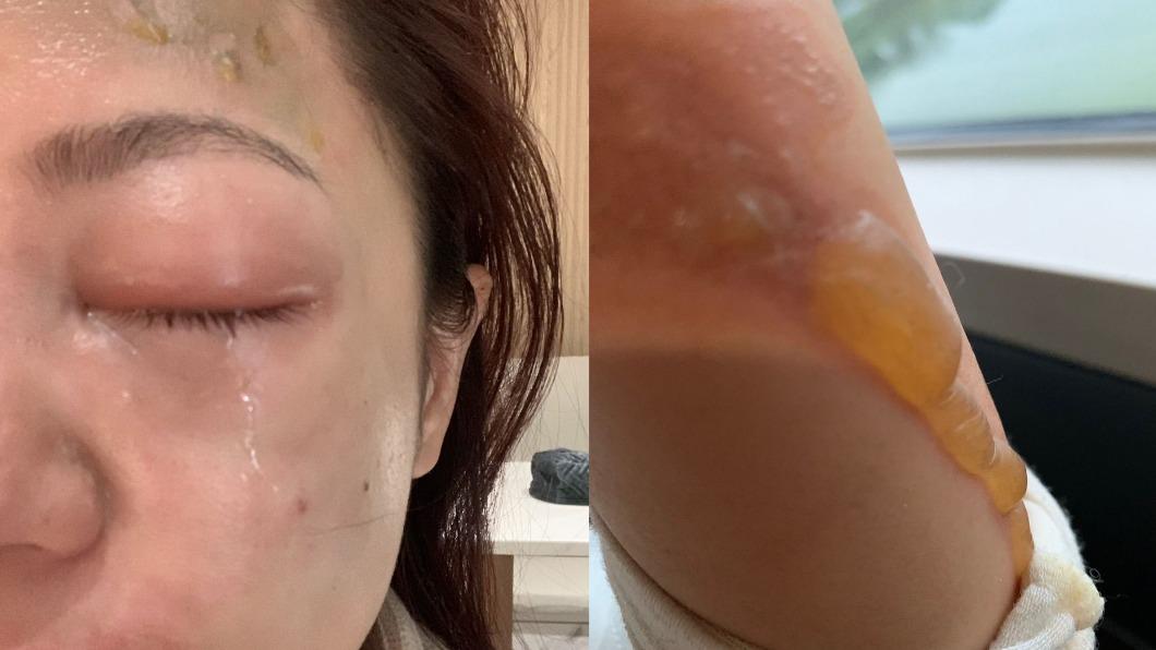 丁噹起初傷口嚴重,多處起水泡外,左眼一度腫到睜不開。(圖/相信音樂提供)