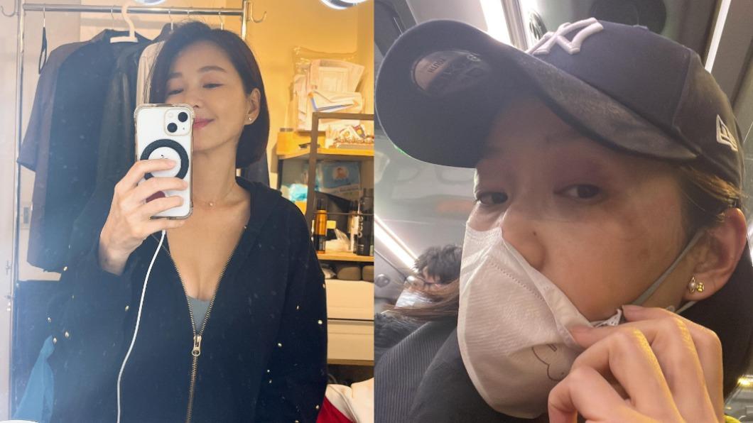 六月深受臉部傷勢所擾,豈料跟她吃的藥物有關。(圖/翻攝自六月臉書)