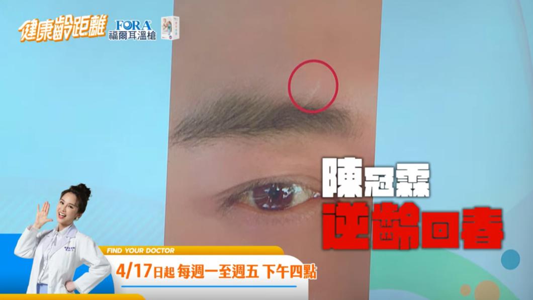 陳冠霖在節目中透露曾不慎跌倒,導致臉曝破相、眼鏡斷裂險失明。(圖/翻攝自健康零距離 YT)