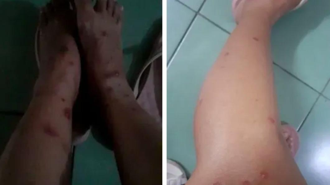 網傳女看護在家顧阿嬤滿腳紅疹染猴痘 羅一鈞回應了