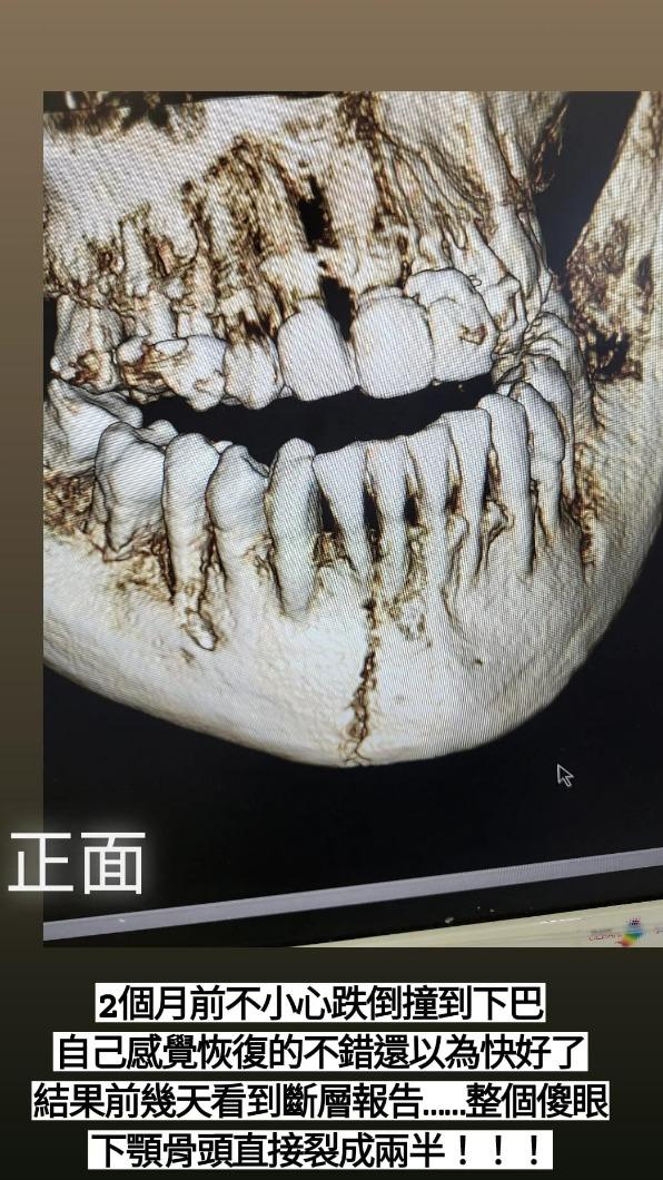 謝金晶摔倒重擊下巴。（圖／豪記唱片提供）