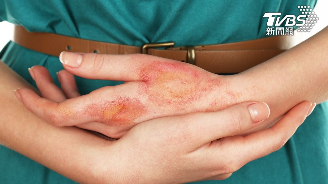 整形醫分享燙傷後第一時間該做的事。（示意圖，非當事人／shutterstock達志影像）