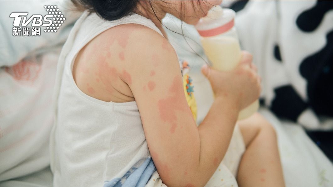 愛吃4健康食物!女童慘嚴重過敏 「全身癢爆」抓破皮流血