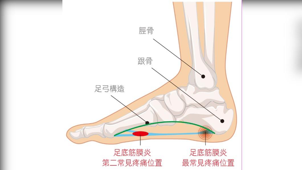 長時間走路可在鞋內加鞋墊,弧度與足弓貼合,緩衝踩地壓力。(圖/院方提供)