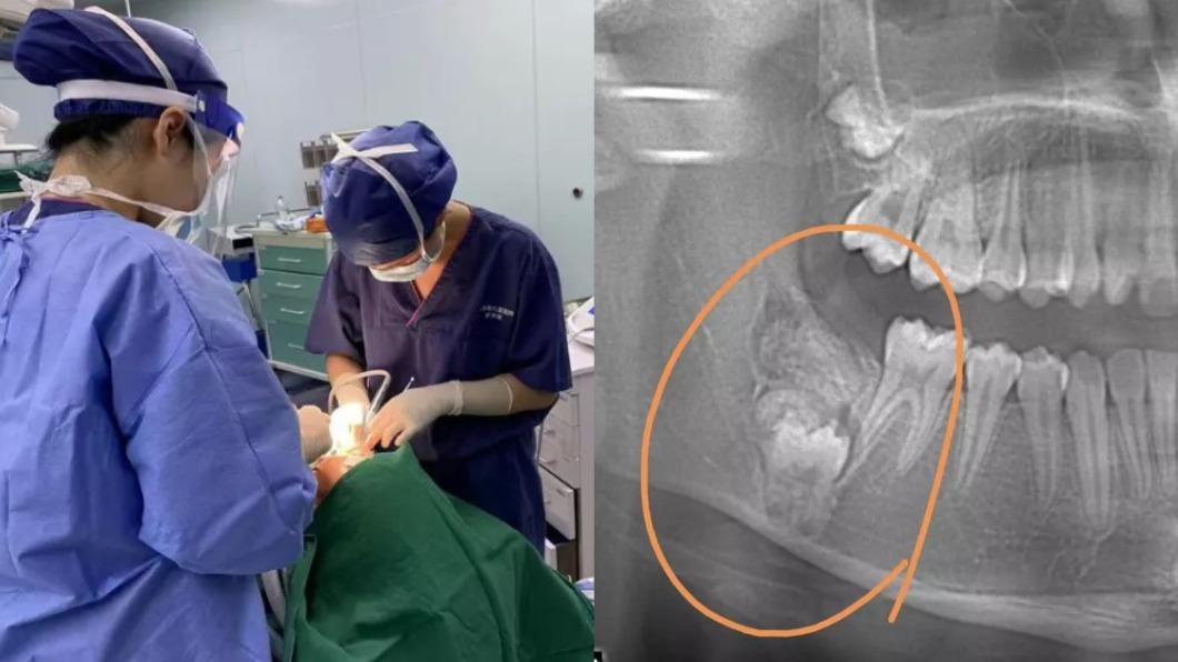 女童矯正牙齒!口腔驚見「病變腫瘤」 醫秒排手術曝病因