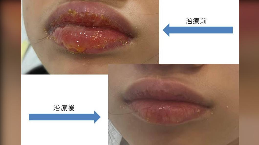 10歲女童診斷為膿痂疹。(圖/診所提供)