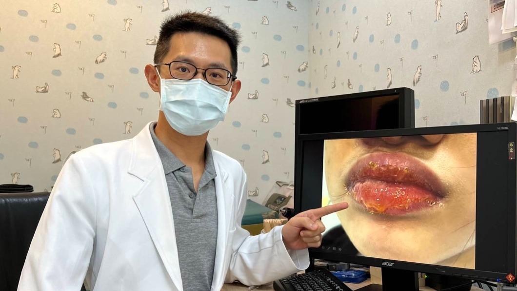 細菌入侵!嘴唇流膿腫如香腸 「兒童好發」嚴重恐蜂窩性組織炎