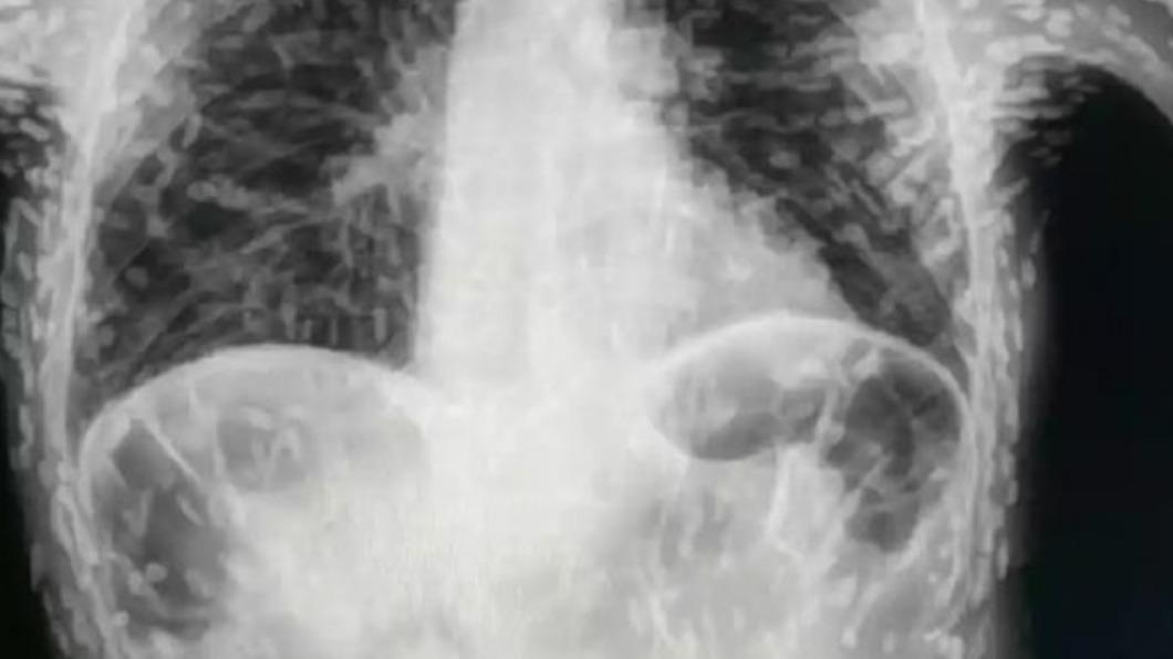 狂咳嗽2個月!醫一照X光「數百寄生蟲卵」 侵3部位恐致命