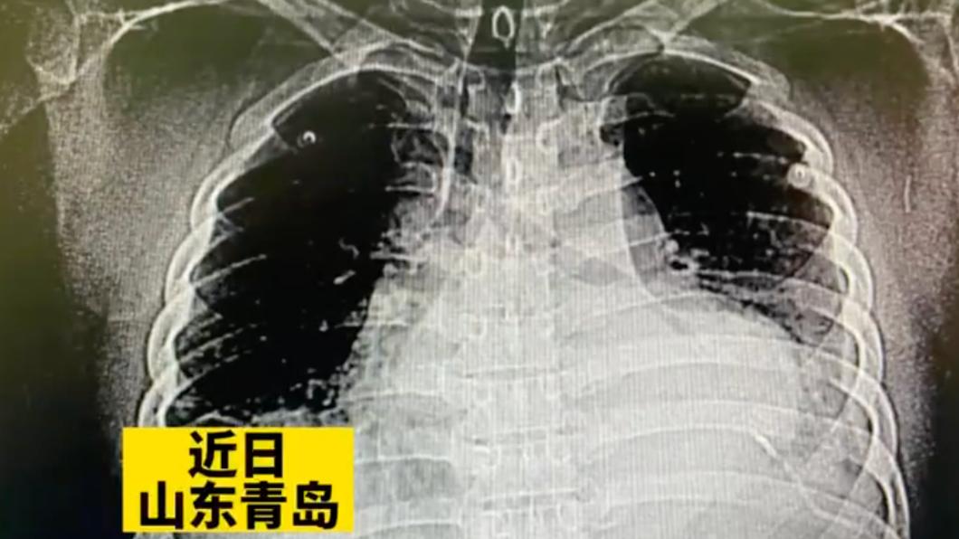 男子體內遺留3公分針頭。（圖／翻攝自《半島都市報》微博）
