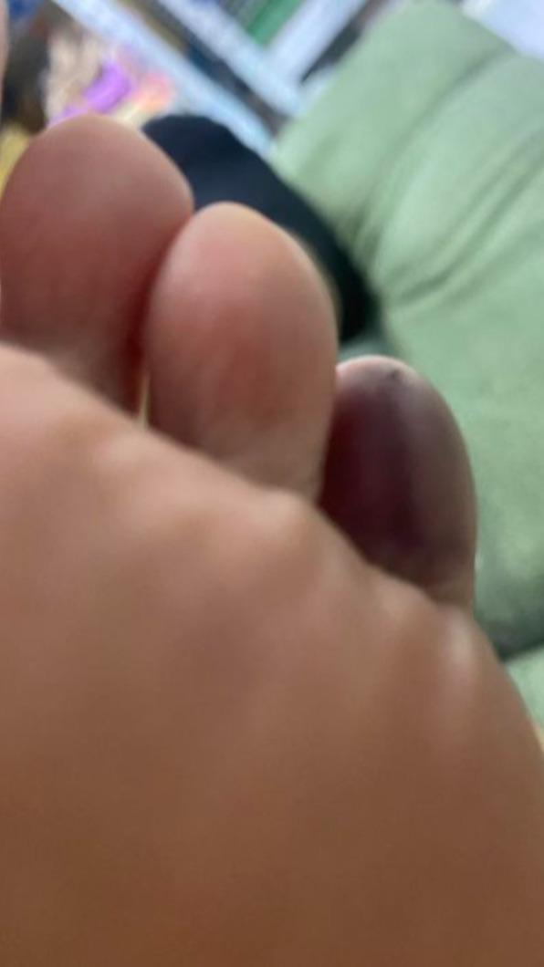 羅巧倫踢到床腳,導致腳趾頭全黑,連走路都感到困難。(圖/翻攝自羅巧倫 臉書)