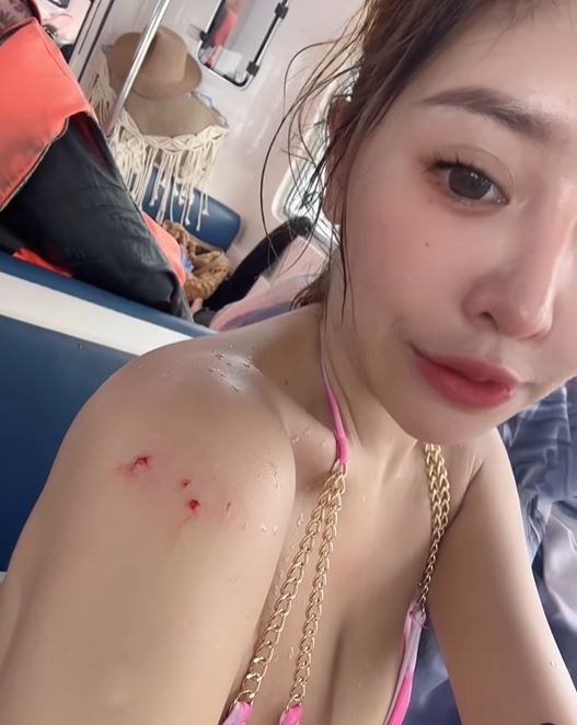 謝侑芯手臂遭鯊魚咬傷。(圖/翻攝自謝侑芯IG)