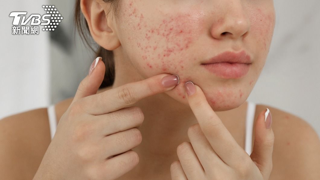 痘痘爬滿臉!戒1物「免吃藥痊癒」 醫:出現9問題是警訊