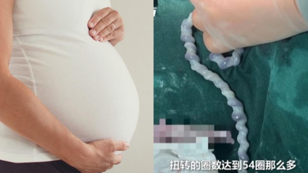 險胎死腹中!新生兒「臍帶扭54圈」成麻花捲 媽急剖腹撿命