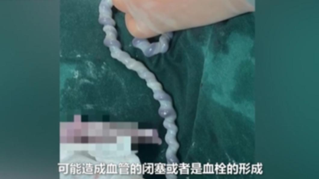 臍帶不通可能導致血栓。（圖／翻攝自微博）