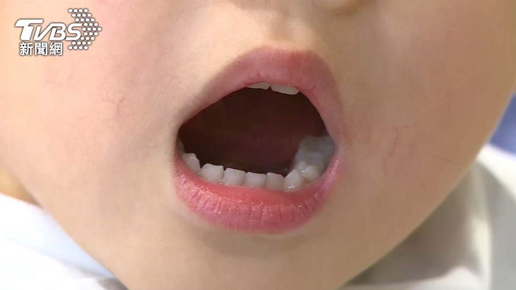 4歲童啃雞翅「牙裂險嗆死」 過年「豬腳、瓜子、牛軋糖」都危險