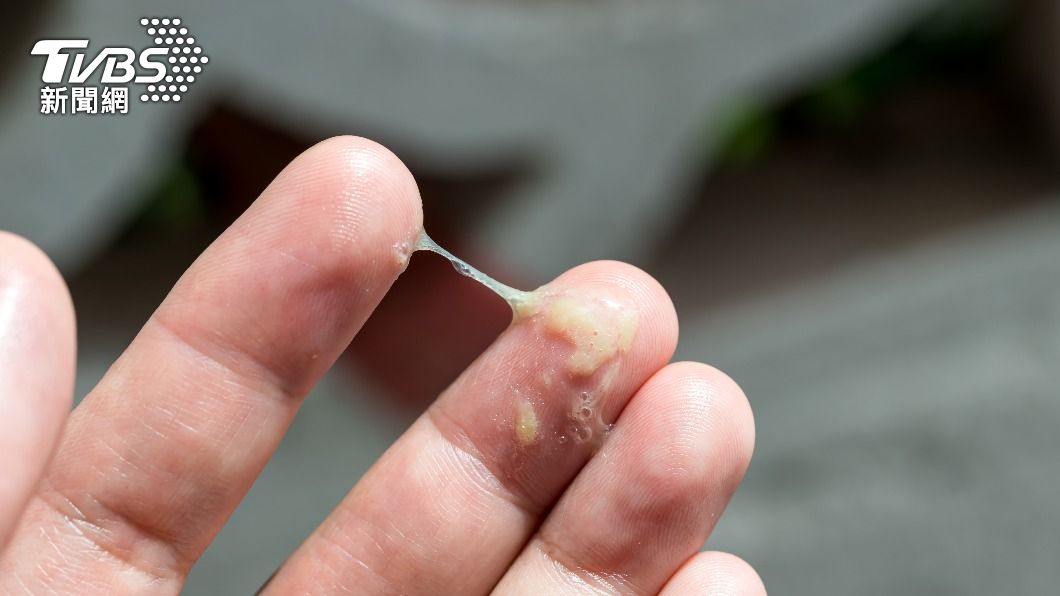 鼻竇黴菌球主要症狀包括濃鼻涕、臭味，可能單邊鼻塞。（示意圖／shutterstock達志影像）