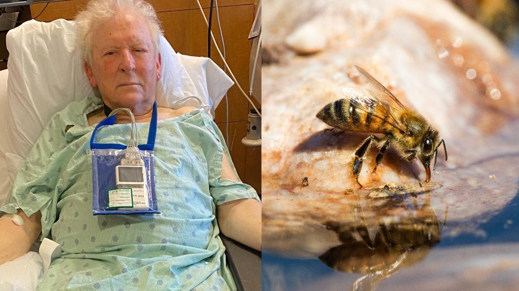 殺人蜂狂螫3小時!醫從8旬翁體內拔出「2百多根毒刺」