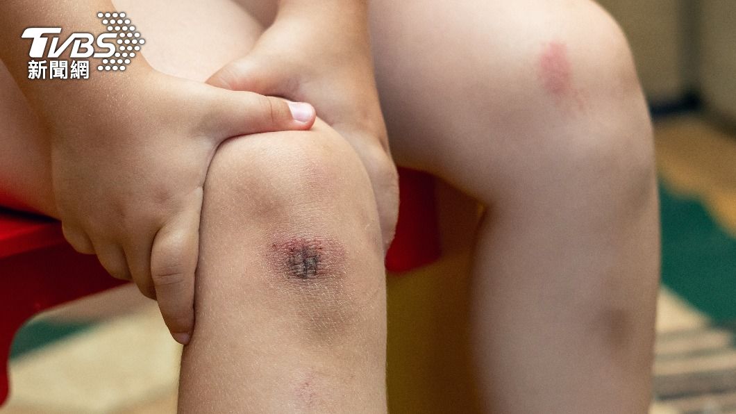 男童身上發現多處陳舊瘀傷。(示意圖,非當事人/shutterstock達志影像)