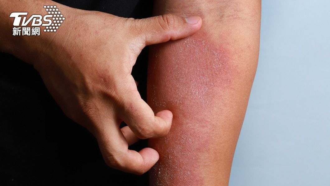 起「熱疹」是熱傷害症狀之一。（示意圖／shutterstock達志影像）