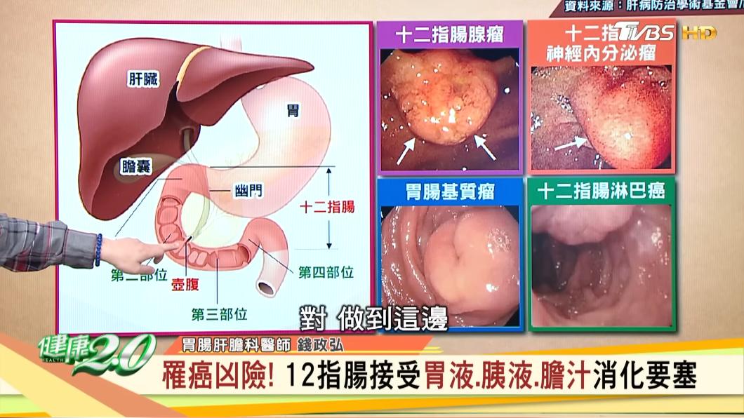 十二指腸癌容易會擴散到附近的組織。（圖／TVBS《健康2.0》）