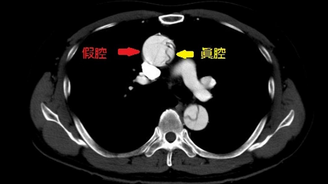 血流將主動脈撕裂成假腔與真,形成「主動脈剝離」。(圖/醫院提供)