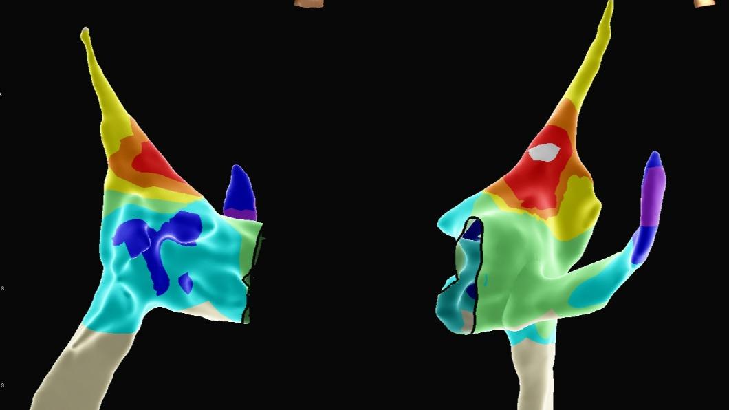 北醫附醫心臟內科使用新型3D立體定位系統進行無輻射電燒治療。(圖/院方提供)