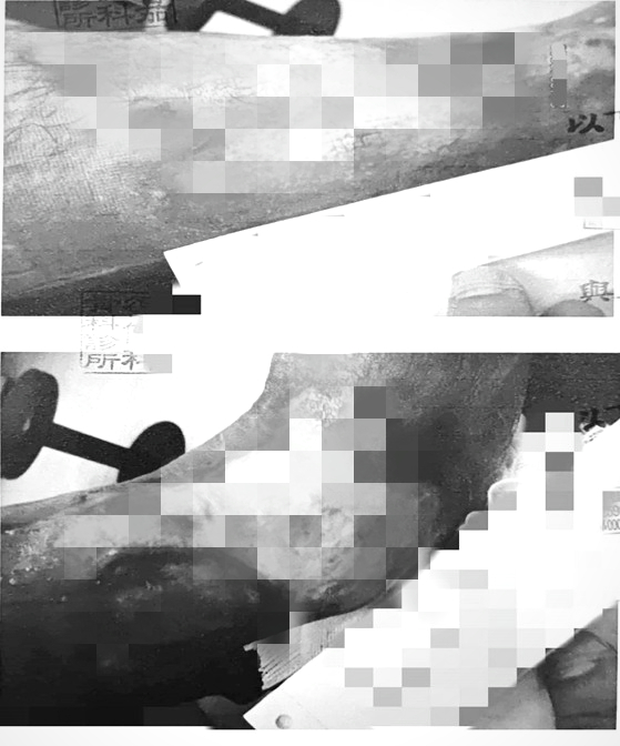 張媽媽表示，兒子在工作時已經被燙傷三次。（圖／羅美文議員提供）