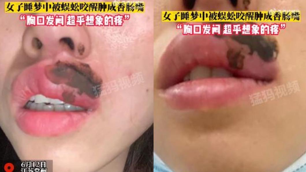 女子半夜被蜈蚣咬醒,且嘴唇在短短幾秒後便腫得跟香腸一樣。(圖/翻攝自微博)