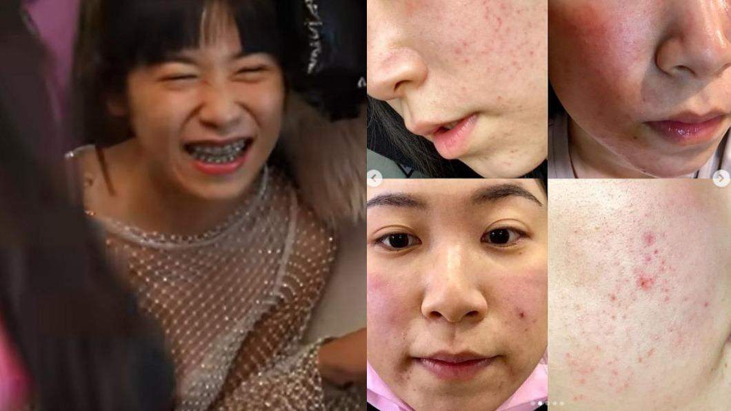 NanaQ在2021年臉部皮膚大發炎,全是疹子。(圖/翻攝自NanaQ IG、林嘉凌 薔薔Maze YouTube)