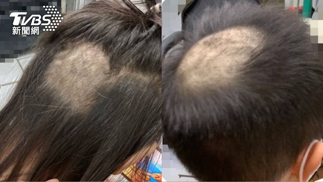 頭頂禿一大塊!新北童驗髮照片曝 家長崩潰:二次傷害